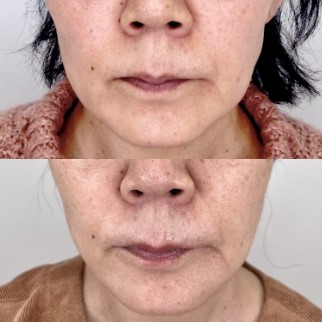 TCB東京中央美容外科のフェイスリフトの症例写真