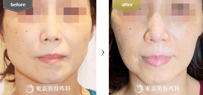 東京美容外科のエラボトックスの症例写真
