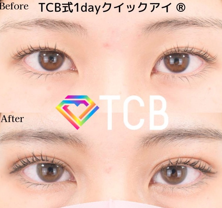 TCB東京中央美容外科の二重整形の症例写真