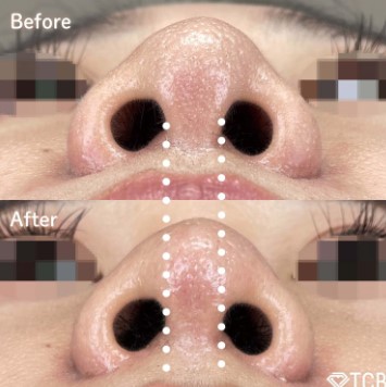 TCB東京中央美容外科の豚鼻整形の症例写真