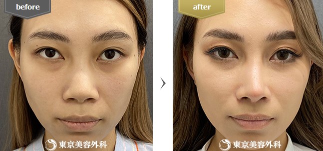 東京美容外科の豚鼻整形の症例写真