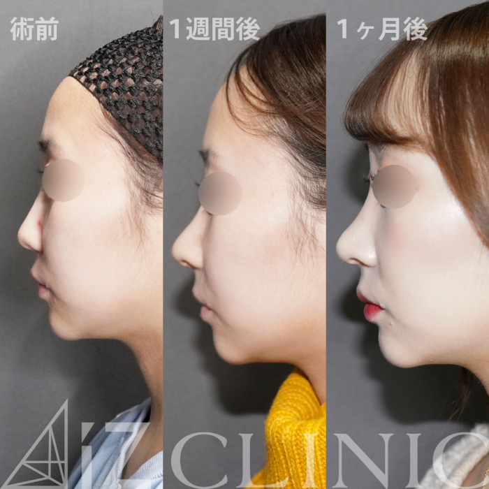 AiZクリニック　鼻尖形成術　症例写真