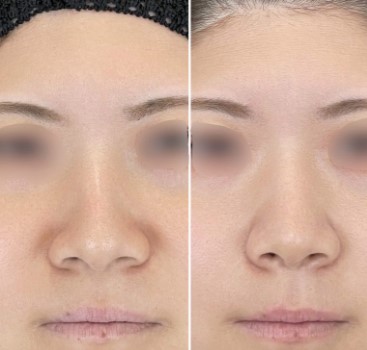 TCB東京中央美容外科の小鼻縮小の症例写真