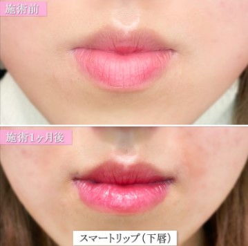 TCB東京中央美容外科の口唇縮小術の症例写真