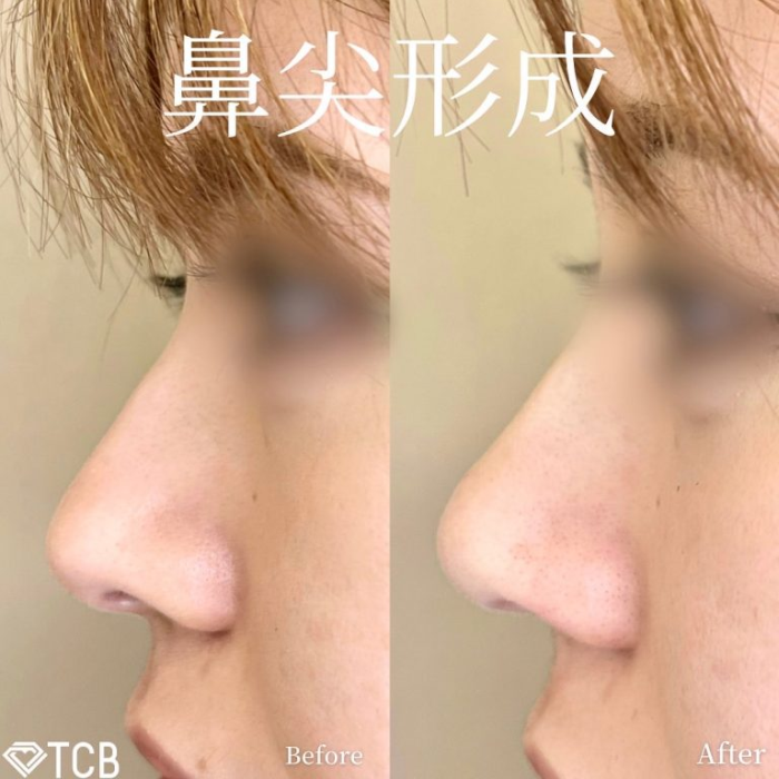 TCB東京中央美容外科　鼻尖形成　症例写真
