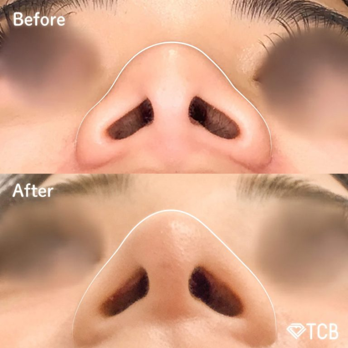 TCB　鼻尖形成術　症例写真