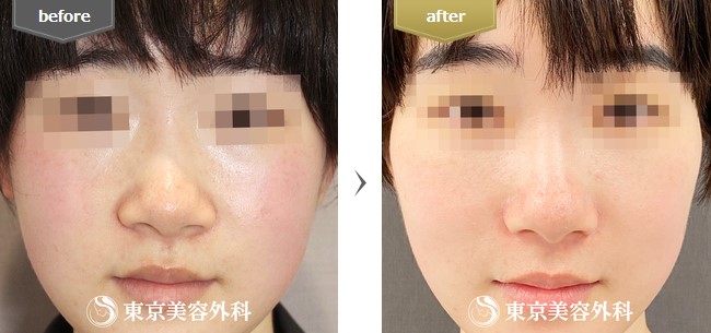 東京美容外科の小鼻縮小の症例写真