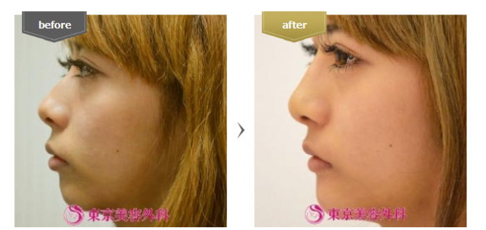 東京美容外科　鼻尖形成術　症例写真