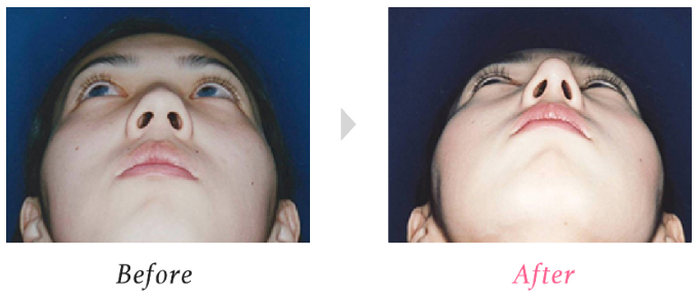 小木曽クリニック　鼻尖形成術　症例写真