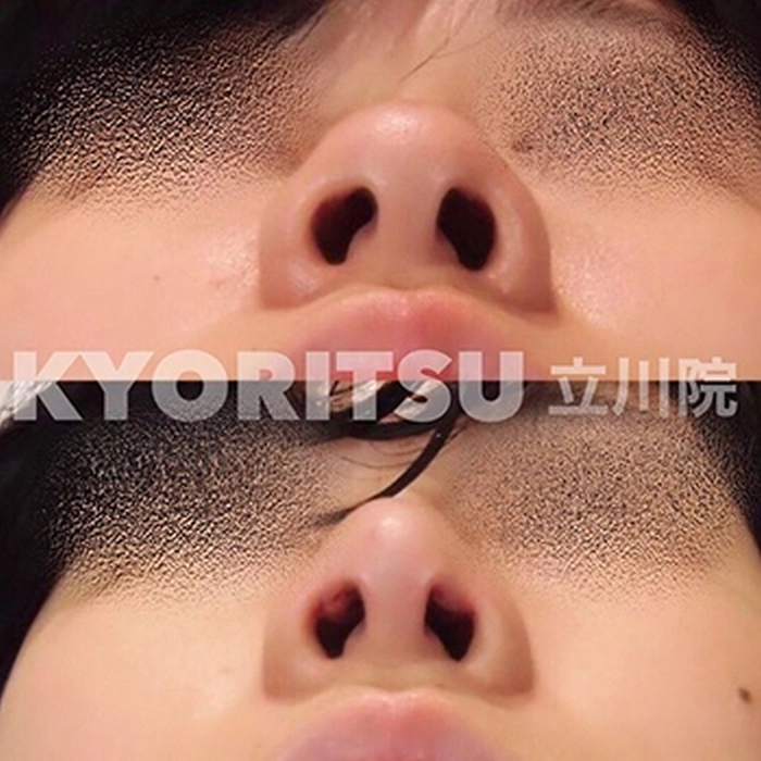共立美容外科　鼻尖形成術　症例写真