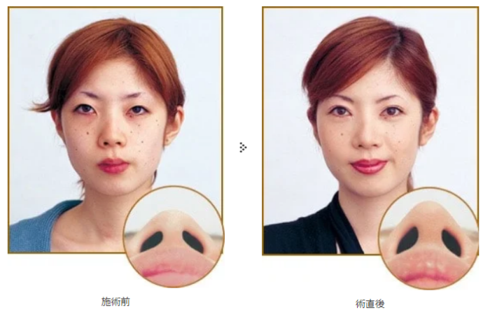 共立美容外科　鼻尖形成術　症例写真