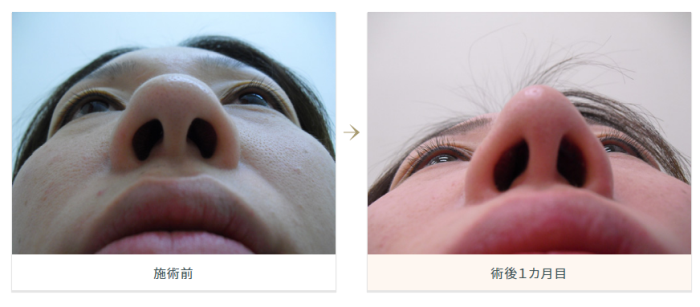 水の森美容クリニック　鼻尖形成術　症例写真