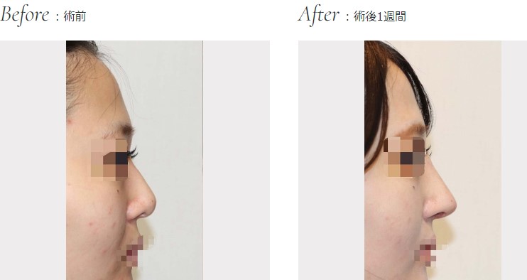 聖心美容外科の鼻整形の症例写真