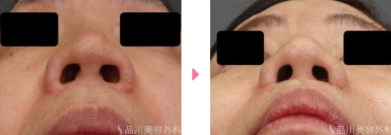 品川美容外科の小鼻縮小の症例写真