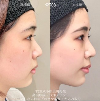 TCB東京中央美容外科の鼻整形の症例写真