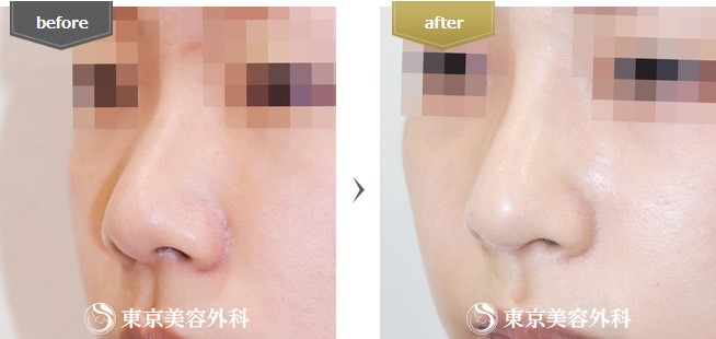 東京美容外科の鼻整形の症例写真