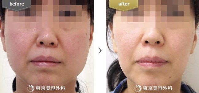 東京美容外科の小顔注射の症例写真
