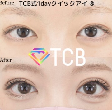 TCB東京中央美容外科　大宮西口院の二重整形症例写真