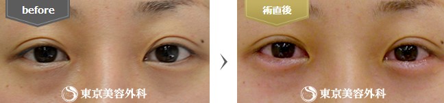 東京美容外科の涙袋ヒアルロン酸注射の症例写真