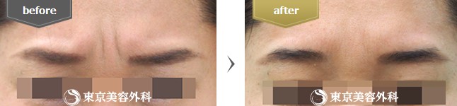 東京美容外科の眉間のシワ整形症例写真