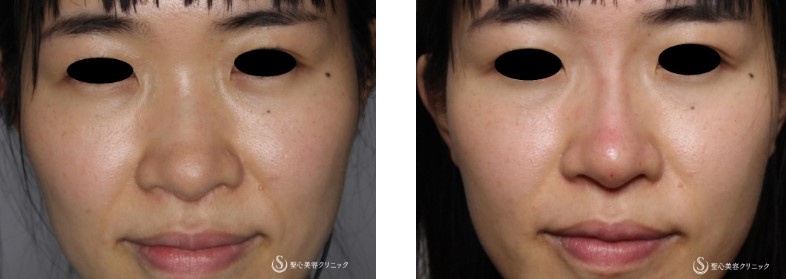 聖心美容クリニックの鼻整形の症例写真
