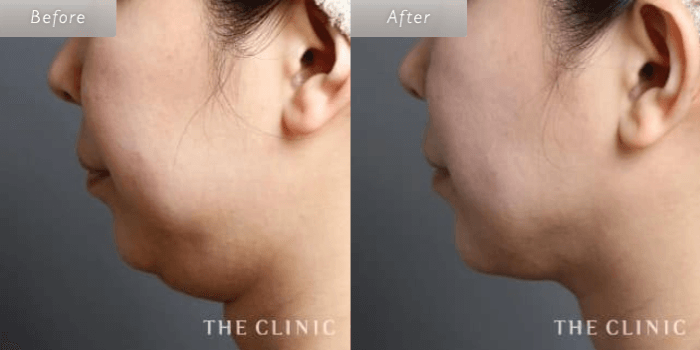 THE CLINIC 大阪の頰／顎のベイザー脂肪吸引の症例写真
