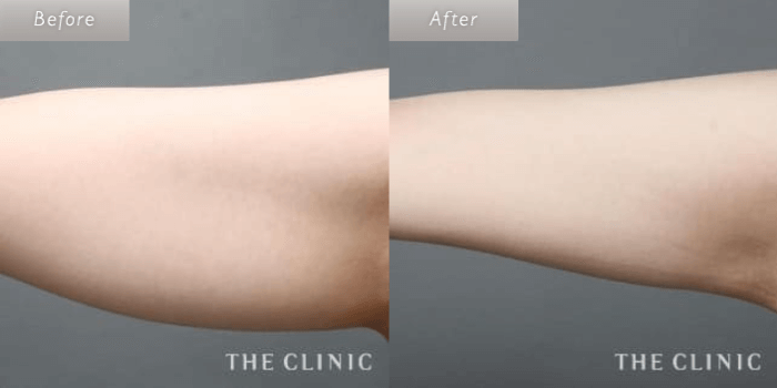 THE CLINIC 大阪の二の腕のベイザー脂肪吸引の症例写真