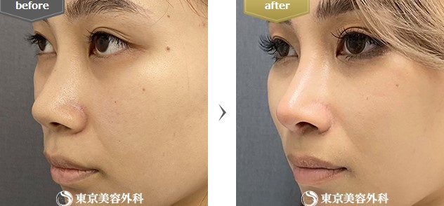 東京美容外科の鼻整形の症例写真