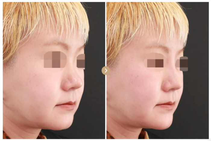 TAクリニック　鼻のヒアルロン酸注入　症例写真