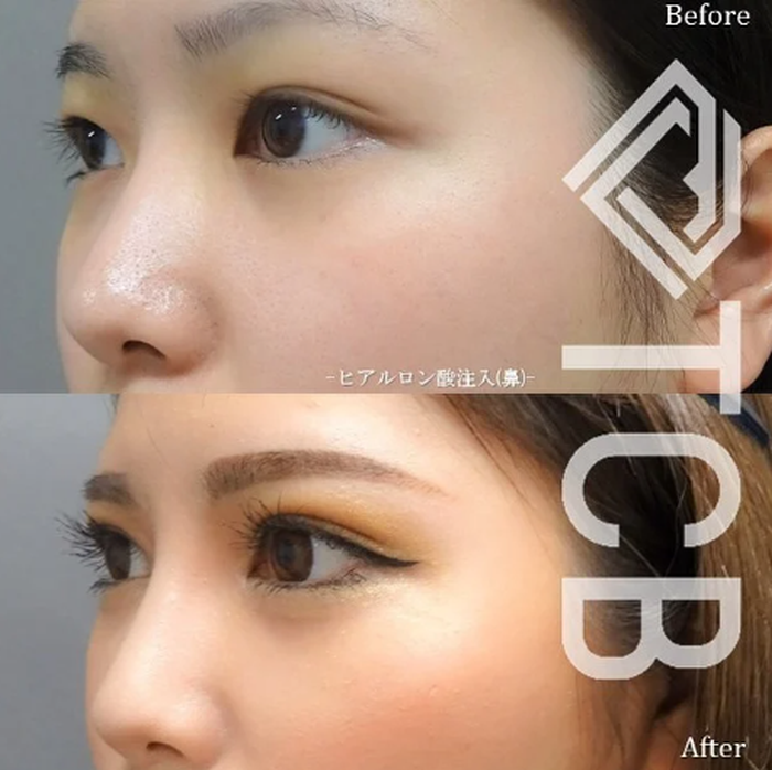 TCB東京中央美容外科　鼻のヒアルロン酸注入　症例写真