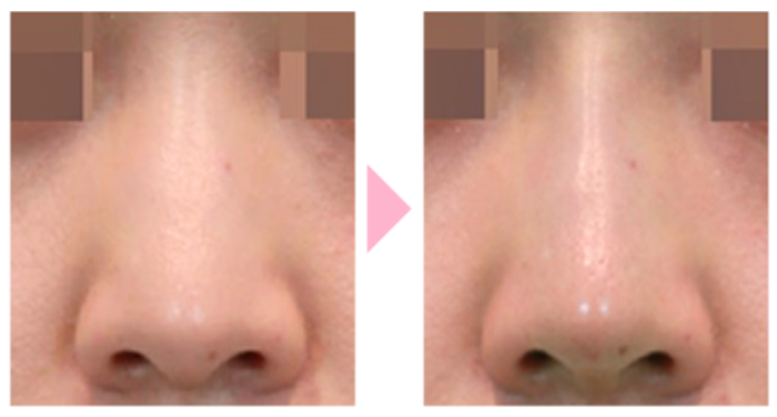 TCB東京中央美容外科　鼻のヒアルロン酸注入　症例写真