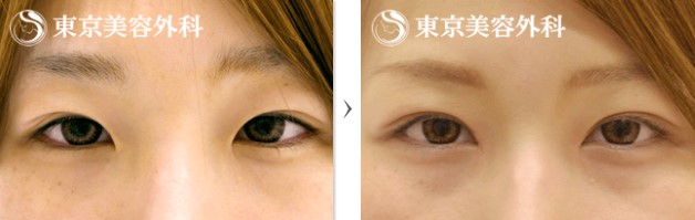 東京美容外科の目頭切開の症例写真