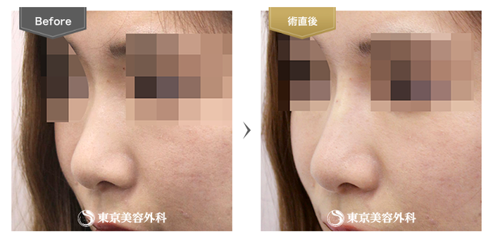 東京美容外科　鼻のヒアルロン酸注入　症例写真