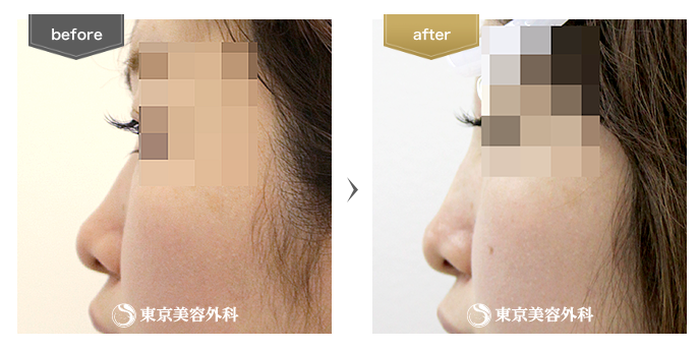 東京美容外科　鼻のヒアルロン酸注入　症例写真