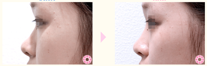 東京形成美容外科　鼻のヒアルロン酸注入　症例写真