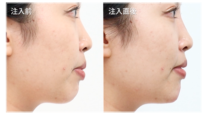 共立美容外科　鼻のヒアルロン酸注入　症例写真