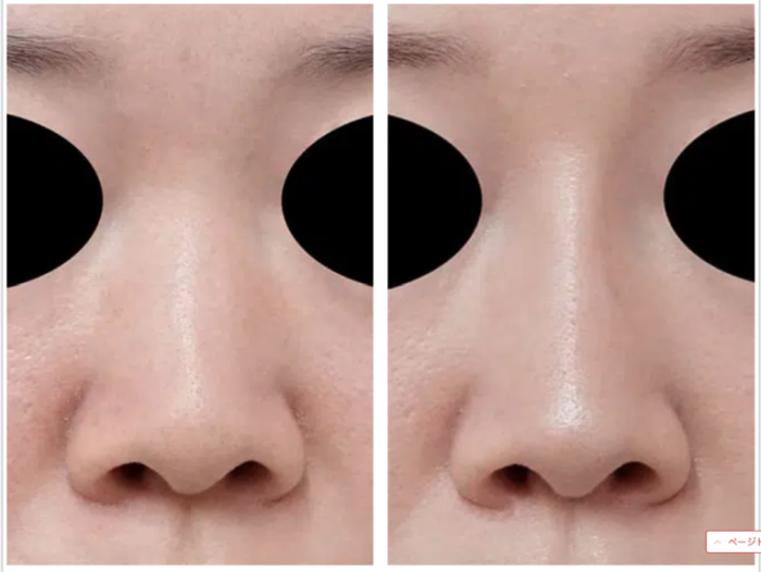 もとび美容外科クリニック 鼻のヒアルロン酸注入　症例写真
