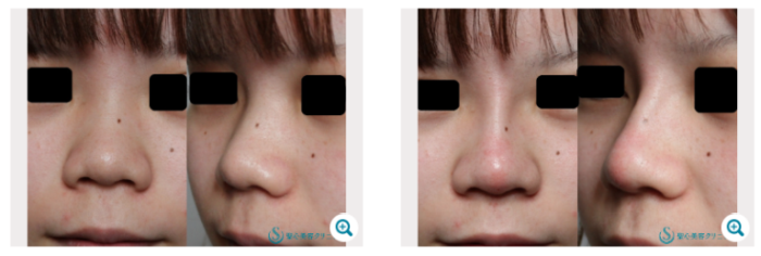 聖心美容クリニック　鼻のヒアルロン酸注入　症例写真