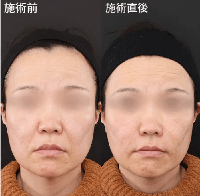 TAクリニックの頬のヒアルロン酸注入の症例写真