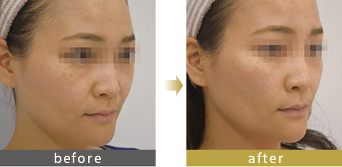 東京美容外科の頬のヒアルロン酸注入の症例写真