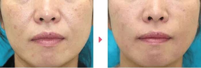 大塚美容形成外科の頬のヒアルロン酸注入の症例写真