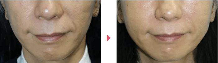 大塚美容形成外科の頬のヒアルロン酸注入の症例写真