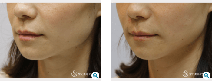 聖心美容クリニックの頬のヒアルロン酸注入の症例写真