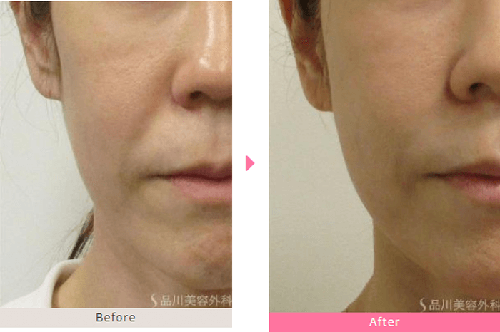 品川美容外科の頬のヒアルロン酸注入の症例写真
