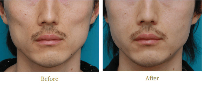 高須クリニックの頬のヒアルロン酸注入の症例写真