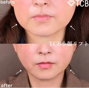 TCB小顔リフトの症例写真