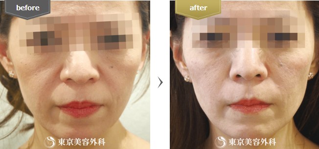 東京美容外科のヒアルロン酸の症例写真