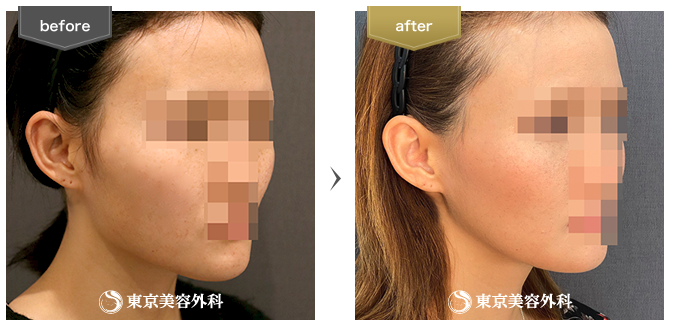 東京美容外科の骨切り奨励写真