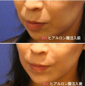 共立美容外科のほうれい線ヒアルロン酸の症例写真