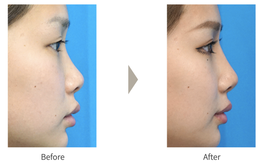 ガーデンクリニックの鼻整形の症例写真